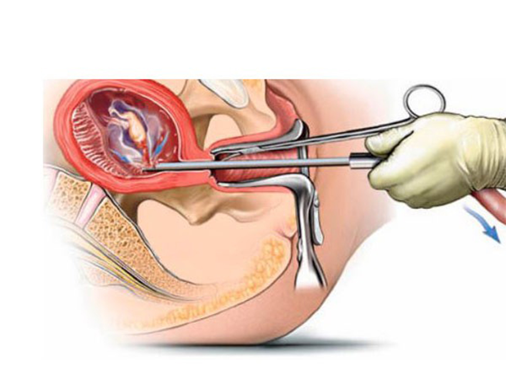 सुरक्षित गर्भपतन गराउने घटे